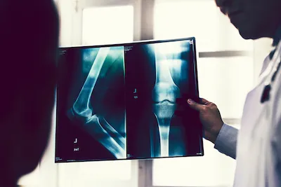 Bone fracture illustration